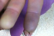 寒冷時手指蒼白，隨後變成紫紅，小心這種常見血管病！