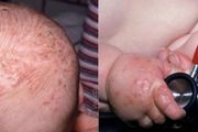 孩子頭上、手腳上的癢癢的膿皰是什麼？