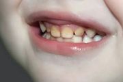 3歲不到的孩子蛀牙了怎麼辦？《指南》來了！