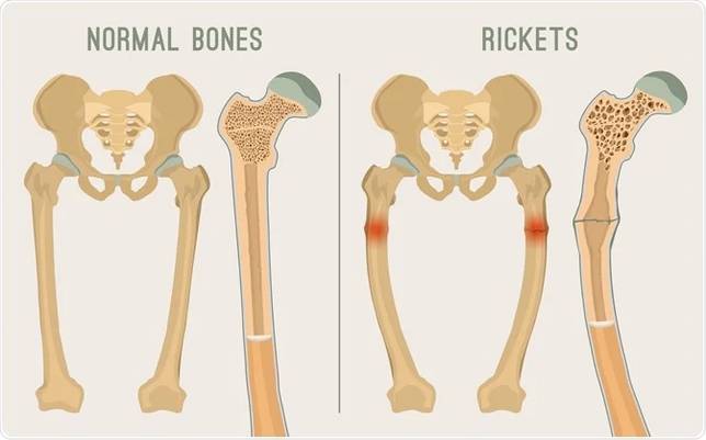 （左圖：正常骨骼；右圖：佝僂病）