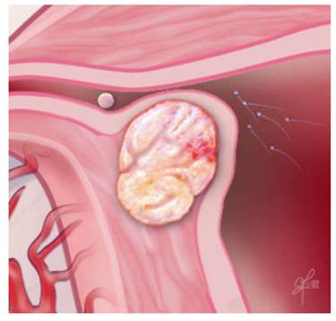 子宮肌瘤影響受精（圖源：參考資料[5]）