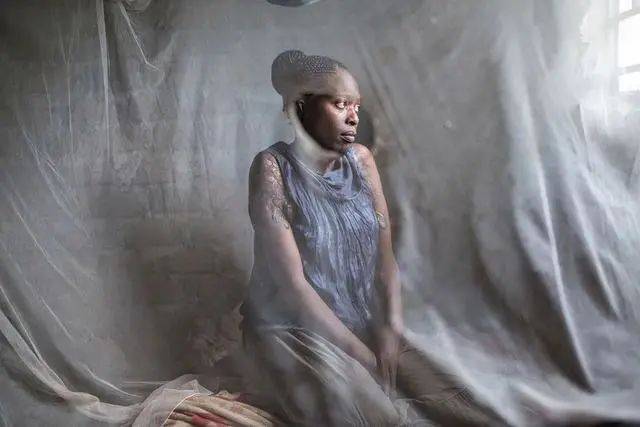 Nalumu，35歲，酸性攻擊倖存者