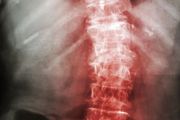 強直性脊柱炎：困擾周杰倫的「不死的癌症」，真的會導致人癱瘓嗎？