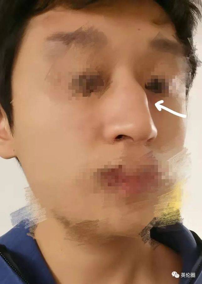 受訪者的鼻子被打歪， 圖：受訪者供圖