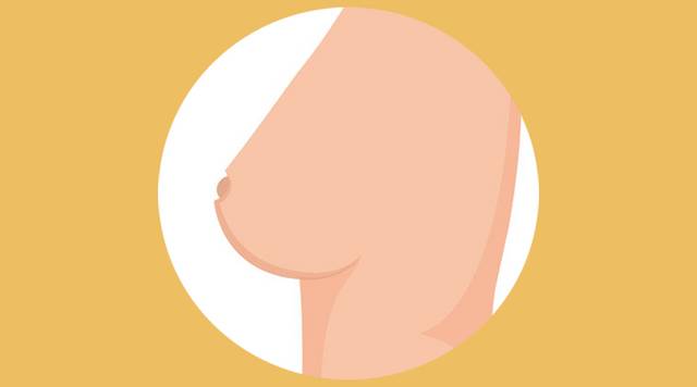 乳腺癌有時會導致乳房組織結構變形