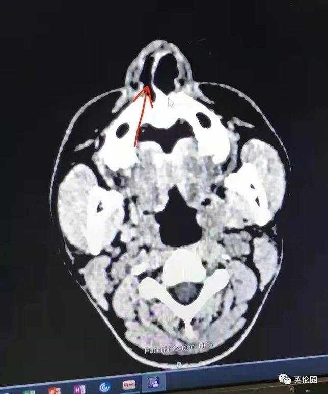 鼻骨骨折，圖：受訪者提供腦部CT圖