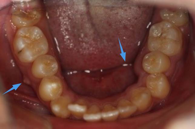 畸形中央尖致兩側下前磨牙根尖周炎