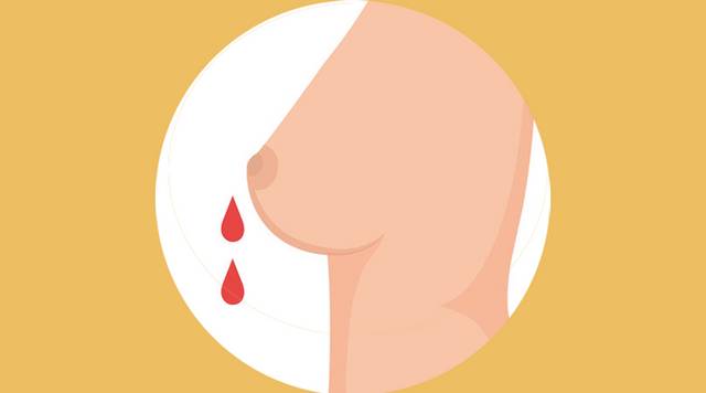 有些乳頭溢液卻可能是乳腺癌的危險信號