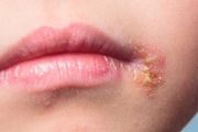 嘴唇邊一熱一癢，皰疹就又起來了——反覆皰疹性齦口炎怎麼辦？