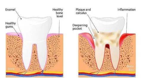左：健康牙周；右：牙周炎