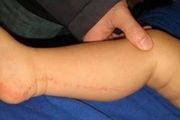 這種長成一條線的皮膚病，超過50%見於5-15歲兒童，你知道是什麼嗎？