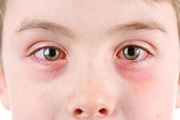 關於孩子過敏性結膜炎，這篇文章講明白了