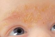 嬰兒頭上的黃痂到底是什麼，怎麼一步步處理？——脂溢性皮炎治療詳細講解