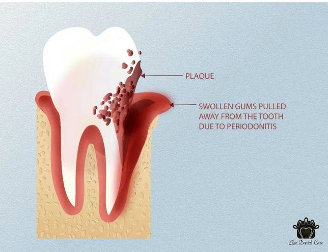 注：腫脹的牙周組織從牙齒上「剝離」