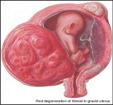 子宮肌瘤紅色變性（圖源：參考資料[5]）
