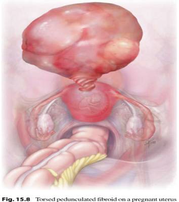 漿膜下子宮肌瘤蒂扭轉（圖源：參考資料[5]）