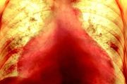 恐怖！最強X光拍攝新冠患者肺部，血管被嚴重破壞！世衛警告：幾百種新冠後遺症要小心！